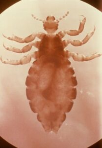 Read more about the article Head Louse
